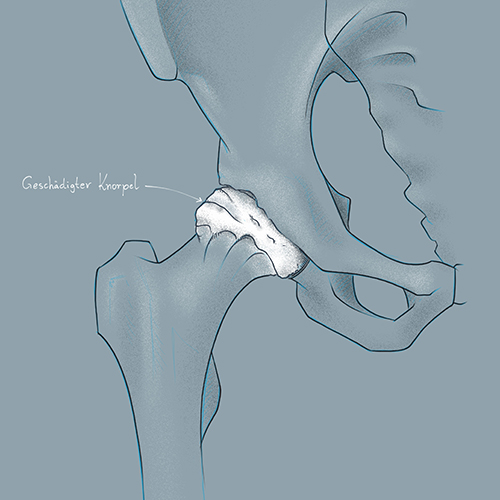 Medical Illustration of Coxarthrosis (Hip Arthrosis)